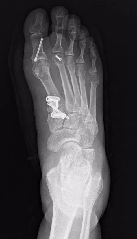 经常穿高跟鞋的你,要注意了!