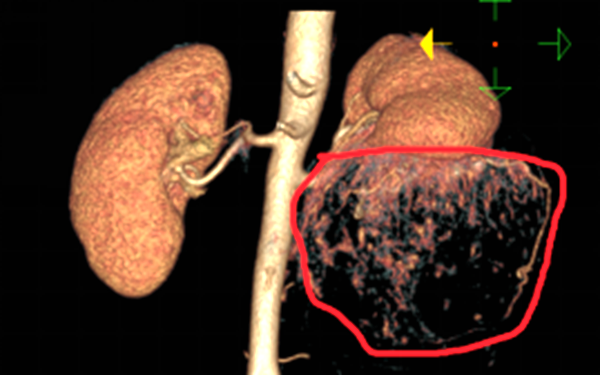 黄石市中心医院多学科团队协作，救治巨大肾错构瘤并出血患者