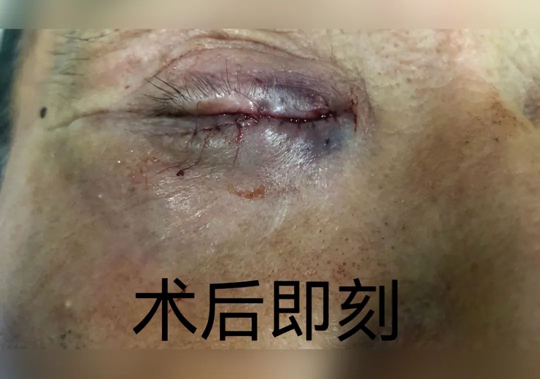 玉田县中医医院眼科成功开展首例睑板腺移植术