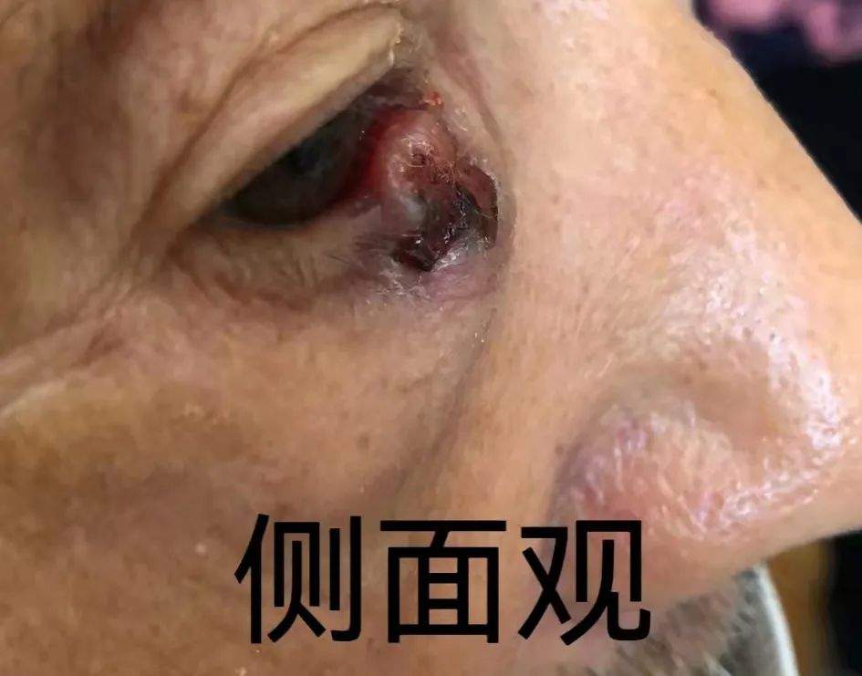 玉田县中医医院眼科成功开展首例睑板腺移植术