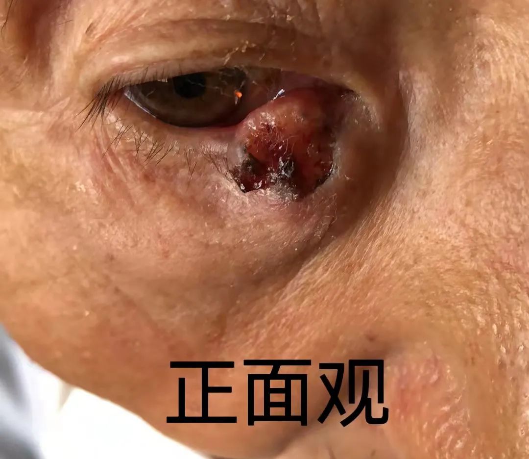 玉田县中医医院眼科成功开展首例睑板腺移植术