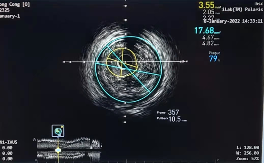 宁城县中心医院心血管介入团队成功完成复杂冠脉介入治疗 3 例