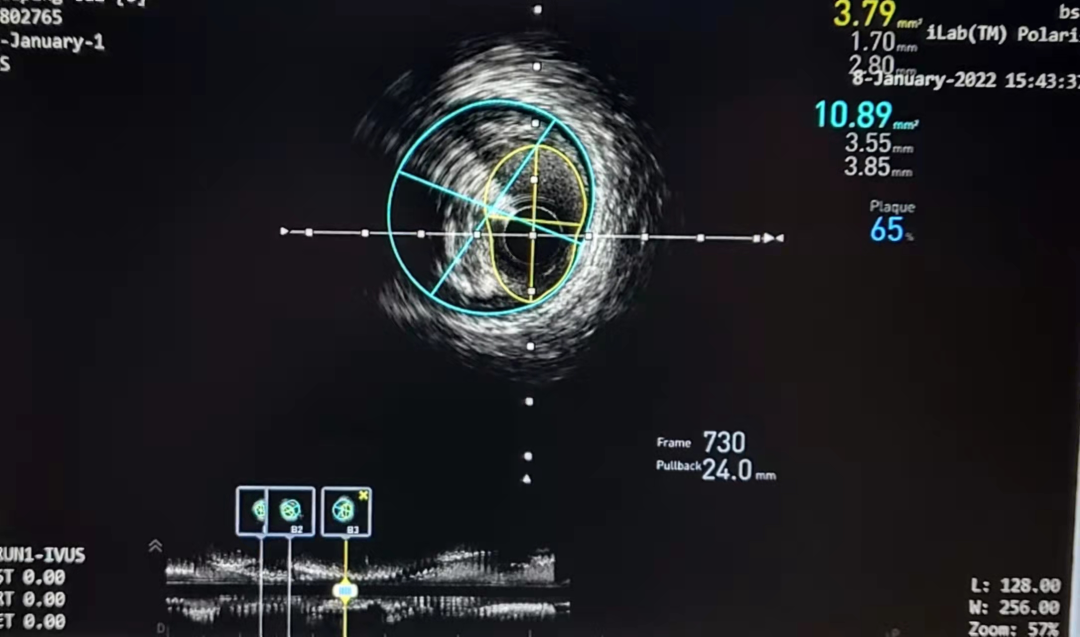 宁城县中心医院心血管介入团队成功完成复杂冠脉介入治疗 3 例