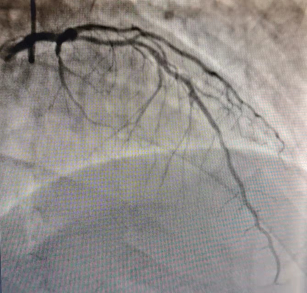 宁城县中心医院心血管介入团队成功完成复杂冠脉介入治疗 3 例