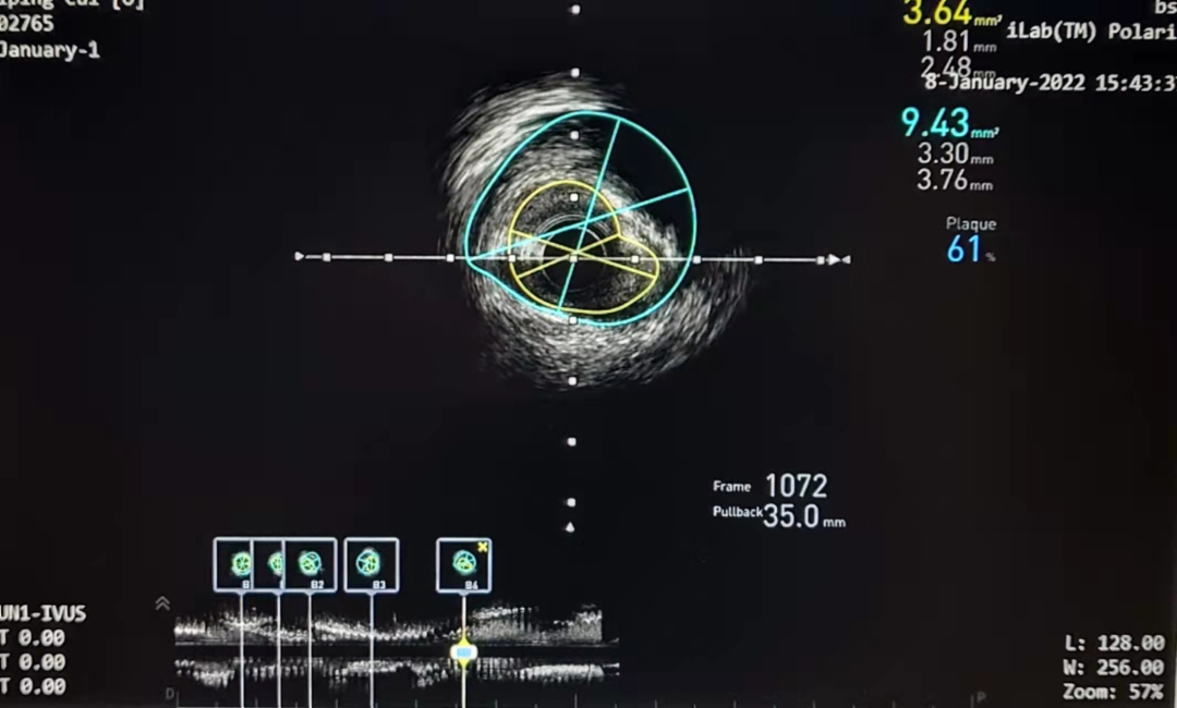 宁城县中心医院心血管介入团队成功完成复杂冠脉介入治疗 3 例