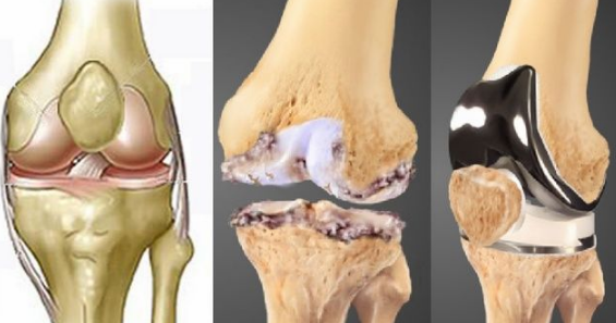 有关膝关节骨性关节炎临床症状及治疗康复