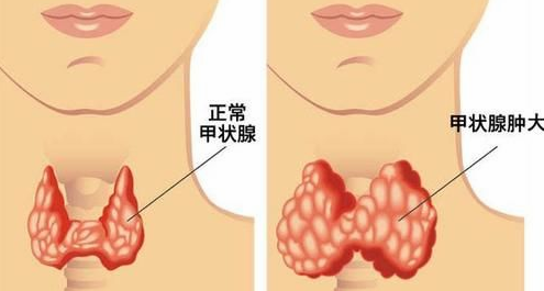 解析甲状腺越来越容易出毛病原因