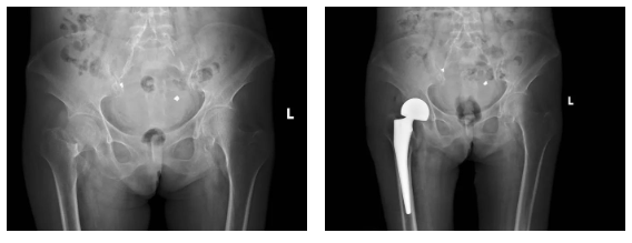 广西壮族自治区人民医院北院院区为一患尿毒症的危重股骨颈骨折患者实施人工股骨头置换术