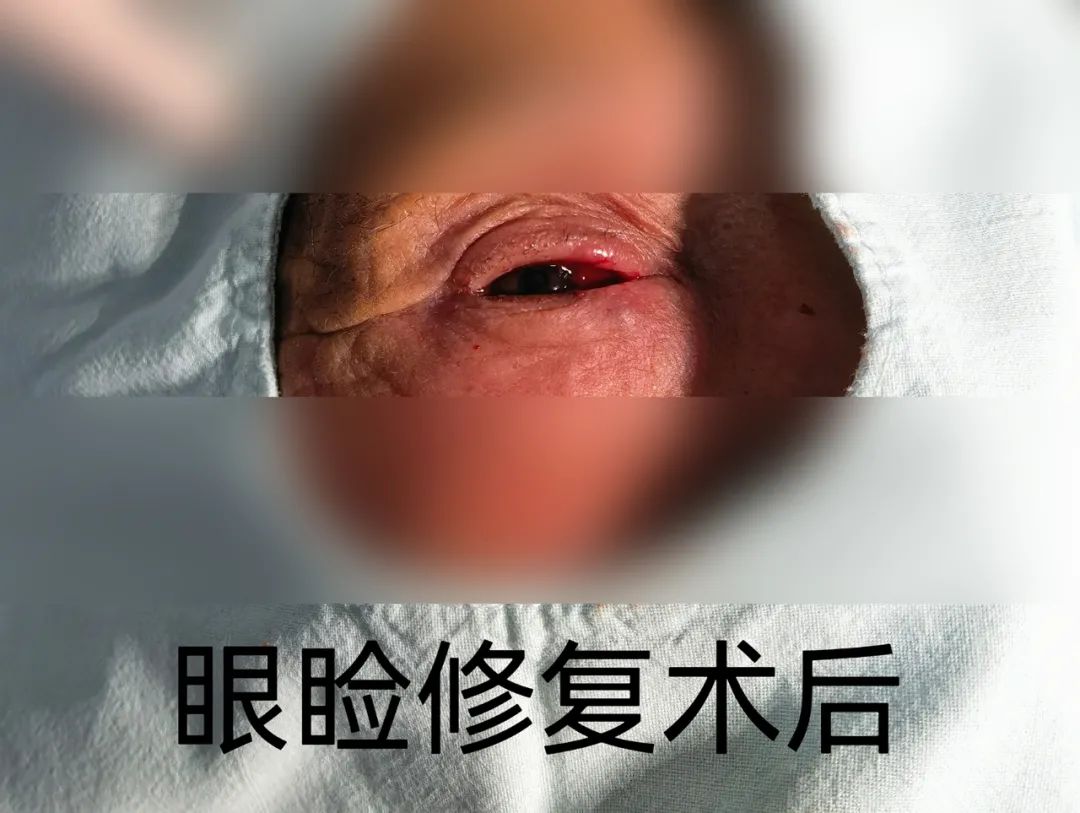 玉田县中医医院眼科成功开展首例睑板腺移植术
