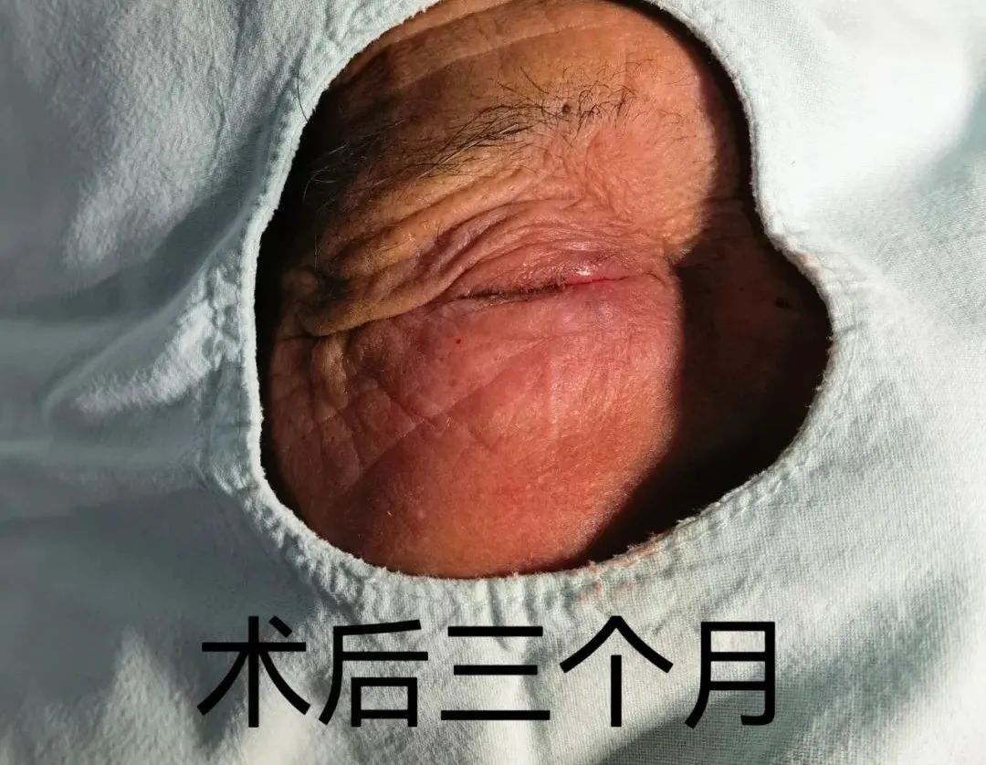 玉田县中医医院眼科成功开展首例睑板腺移植术