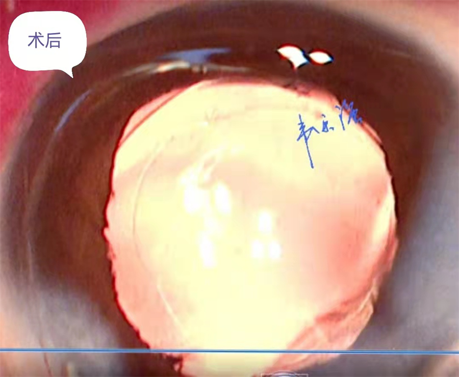 柳州市红十字会医院借助虹膜扩张器扩大瞳孔成功完成一例白内障手术