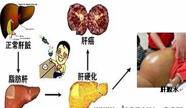 肝硬化腹水是什么病 企业动态 丁香通