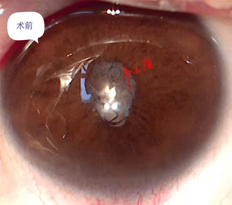 柳州市红十字会医院借助虹膜扩张器扩大瞳孔成功完成一例白内障手术