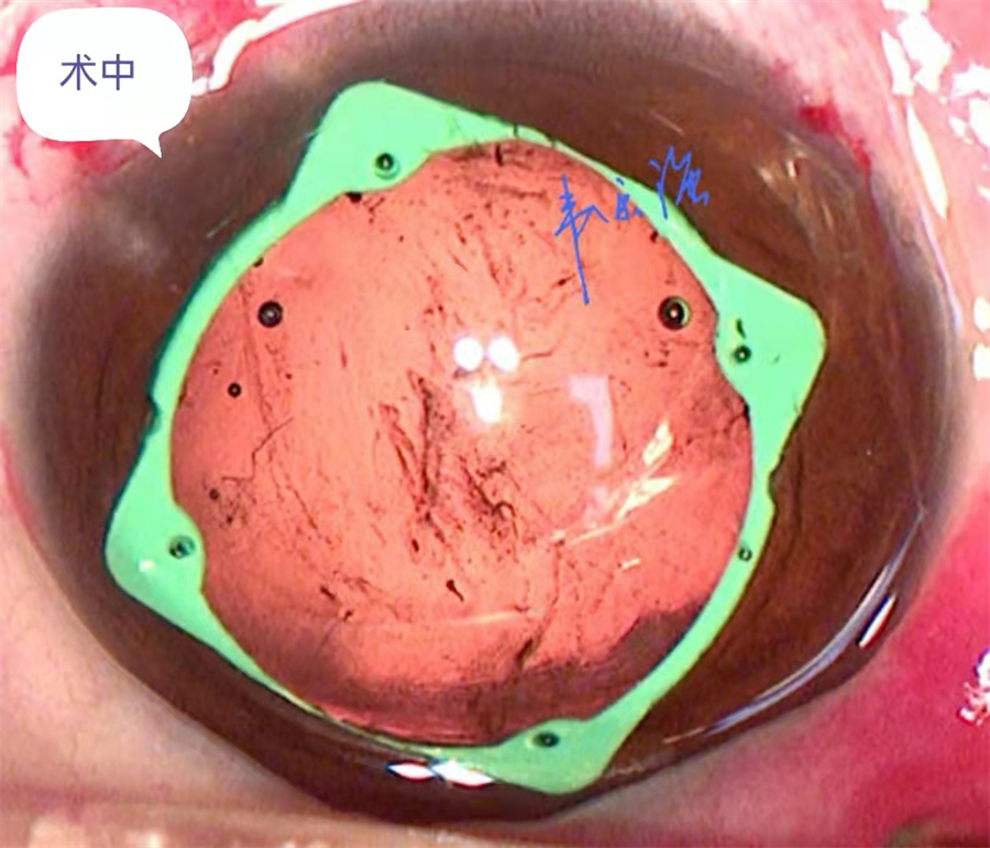 柳州市红十字会医院借助虹膜扩张器扩大瞳孔成功完成一例白内障手术