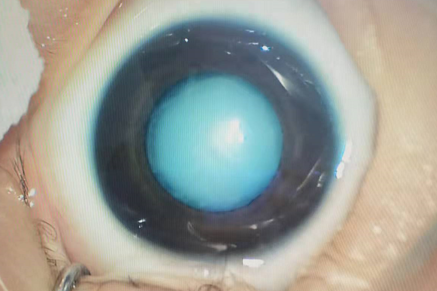 「小白」闯关记——如何战胜先天性白内障