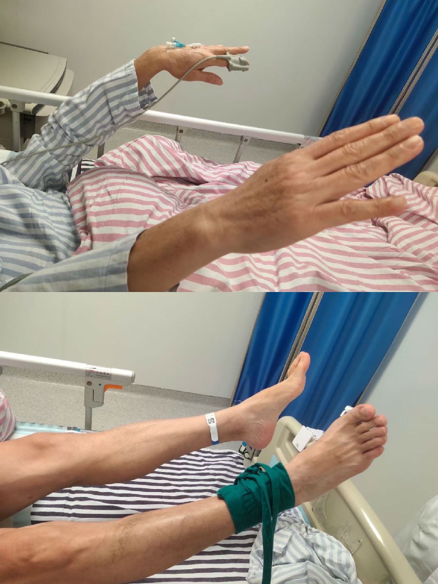 广西壮族自治区人民医院神经内科把握「黄金时间」挽救脑卒中患者