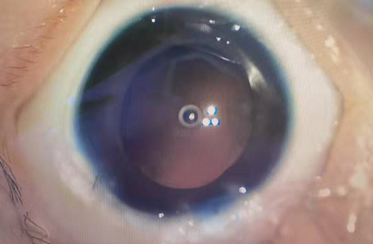 「小白」闯关记——如何战胜先天性白内障