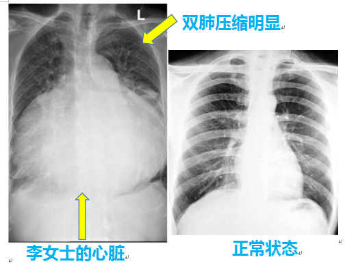 心「大」了也不好——云南阜外心血管医院成功救治一名罕见巨大心脏患者