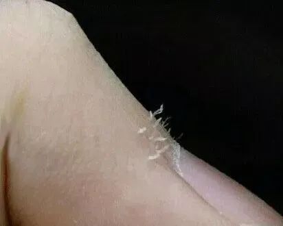 指甲旁边长倒刺,是缺维生素?