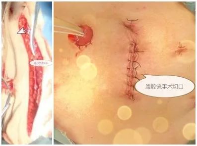 膀胱切除了咋个尿尿?