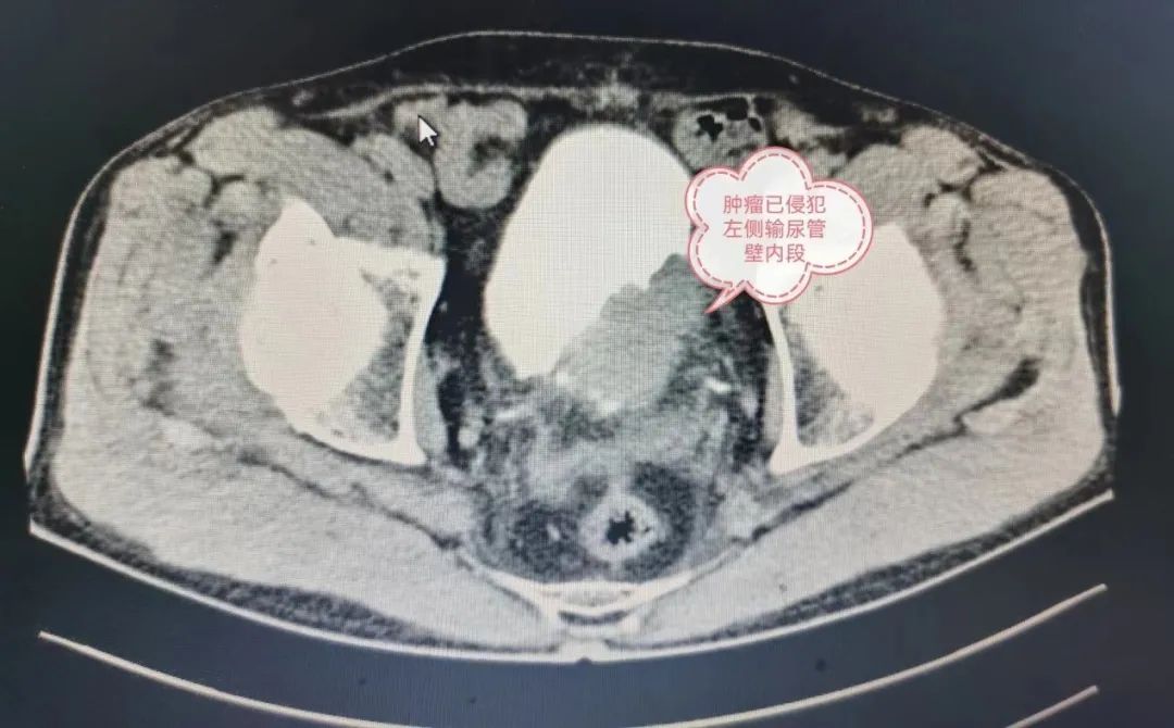 膀胱切除了咋个尿尿?