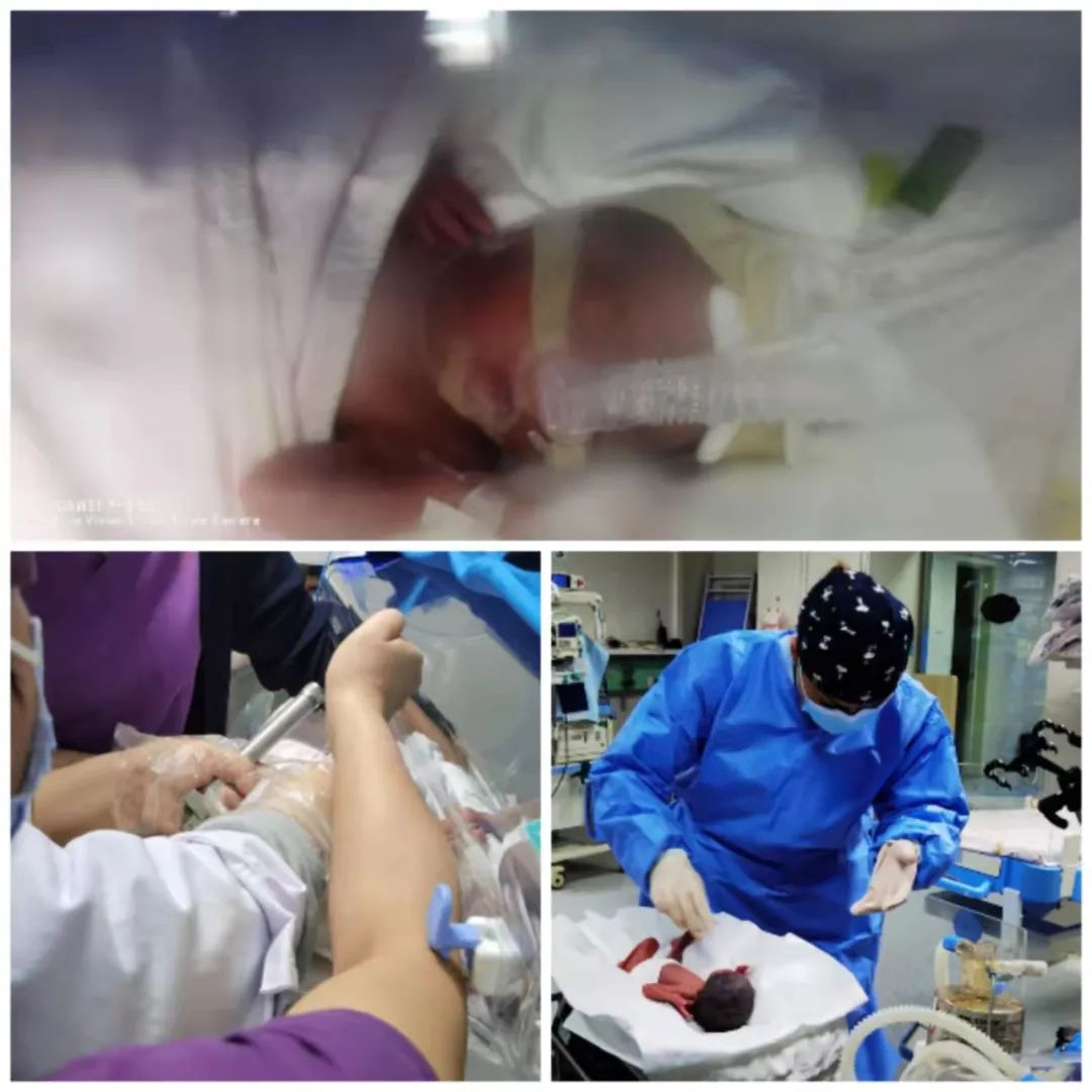 体重 950 g、28 周的早产宝宝患新生儿呼吸窘迫综合征，MIST 技术助闯「生死关」