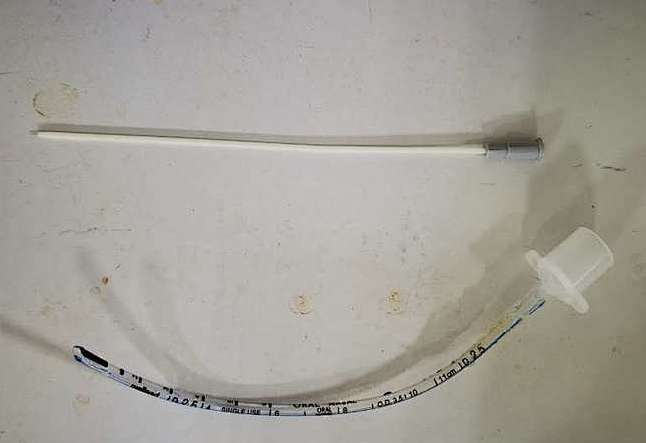 体重 950 g、28 周的早产宝宝患新生儿呼吸窘迫综合征，MIST 技术助闯「生死关」