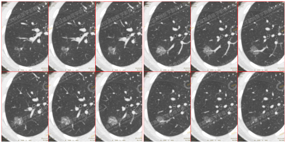 高尚案例:肺磨玻璃结节 GGN 6 例