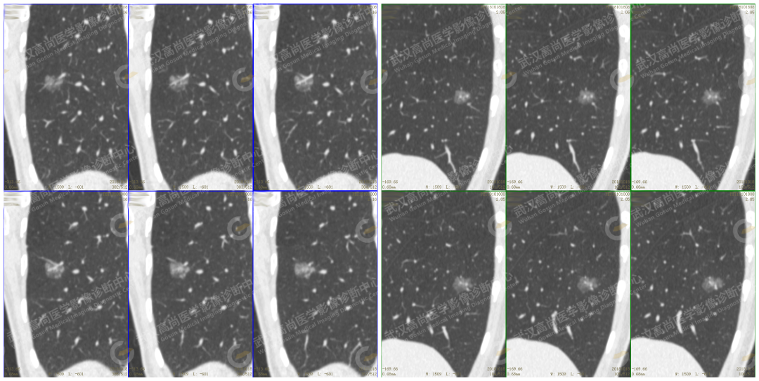 高尚案例:肺磨玻璃结节 GGN 6 例