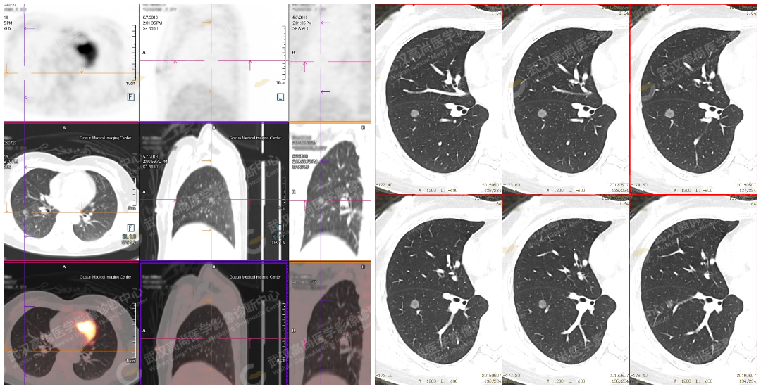 高尚案例:肺磨玻璃结节 GGN 6 例