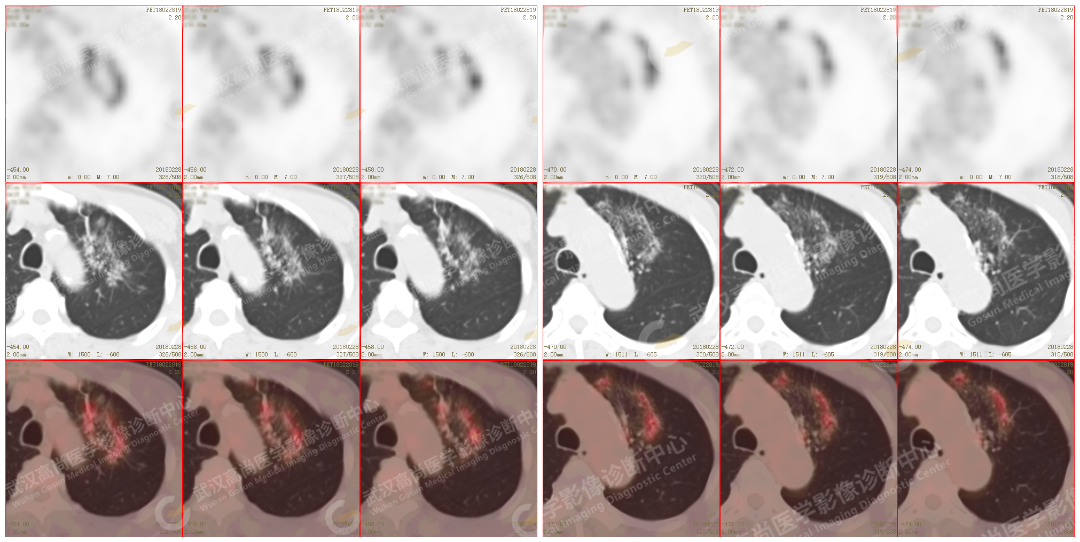 高尚案例:肺磨玻璃结节 GGN 6 例