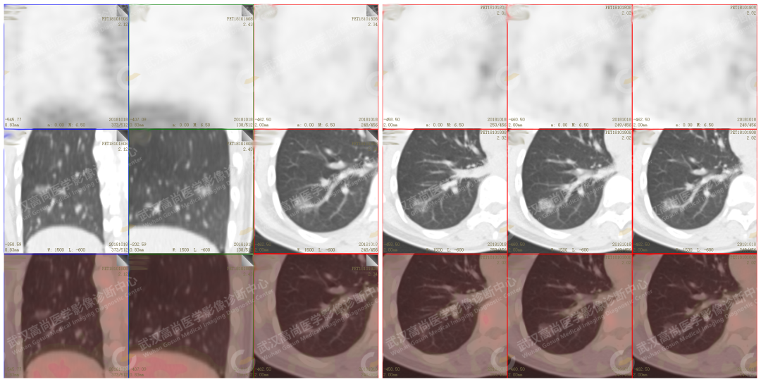 高尚案例:肺磨玻璃结节 GGN 6 例