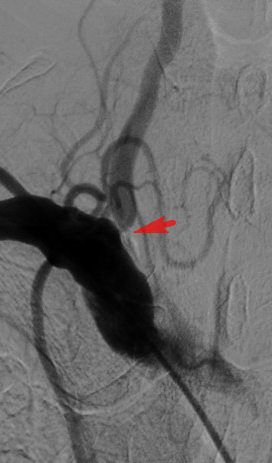 一枚自带 buff 的支架，解决七旬老伯头晕难题