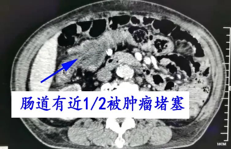 得了肠癌的尿毒症患者：我想做完手术后，就能马上透析！安排！！！