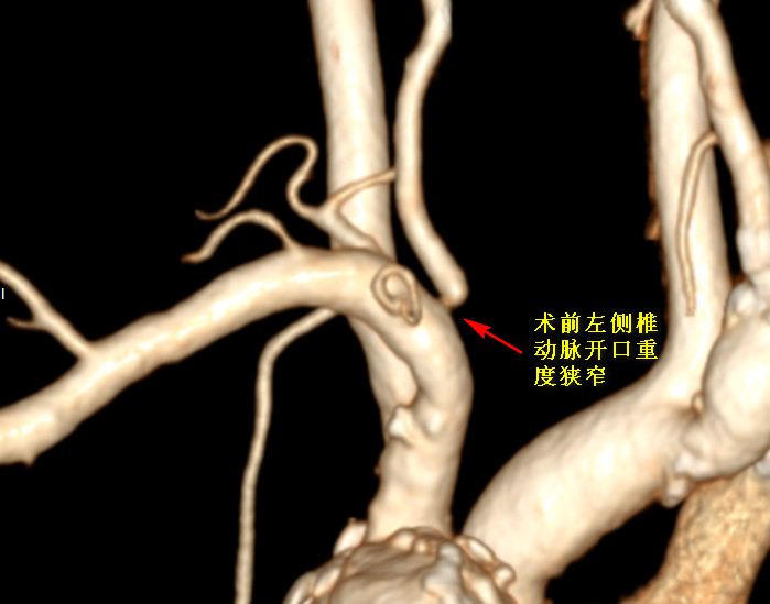 一枚自带 buff 的支架，解决七旬老伯头晕难题