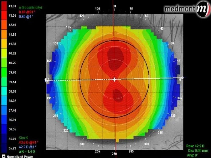 圆锥角膜地形图案例图片