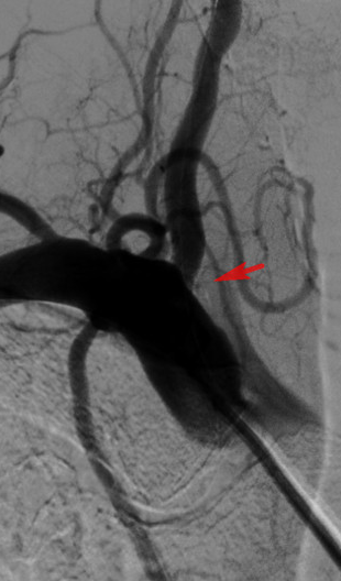 一枚自带 buff 的支架，解决七旬老伯头晕难题