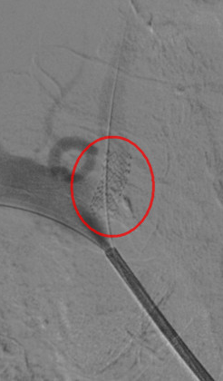 一枚自带 buff 的支架，解决七旬老伯头晕难题