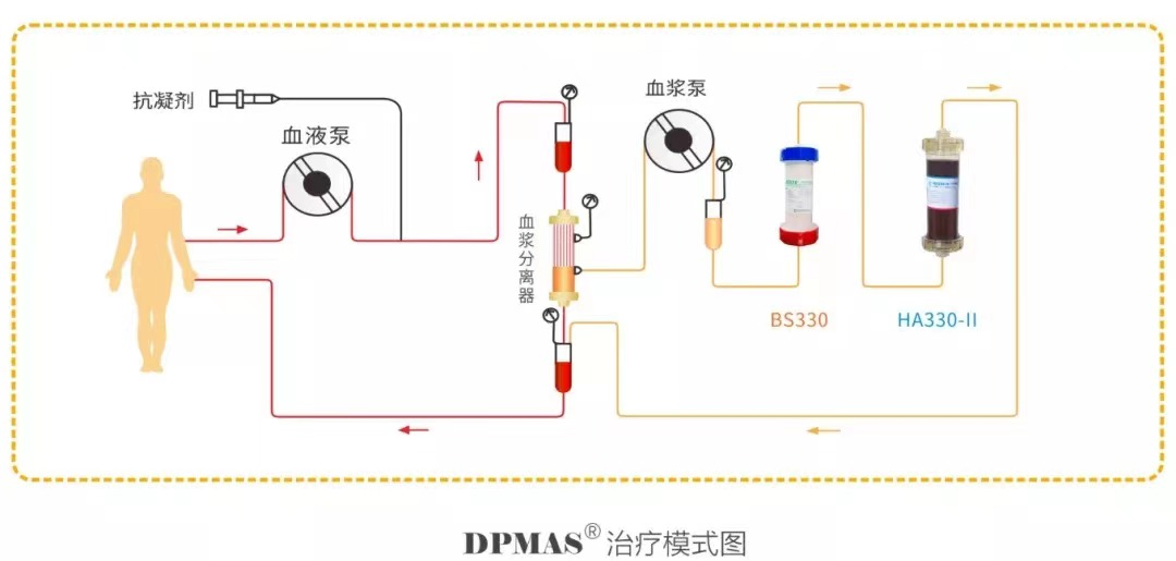 肝不「动」了,人工肝助肝癌「小黄人」获新生