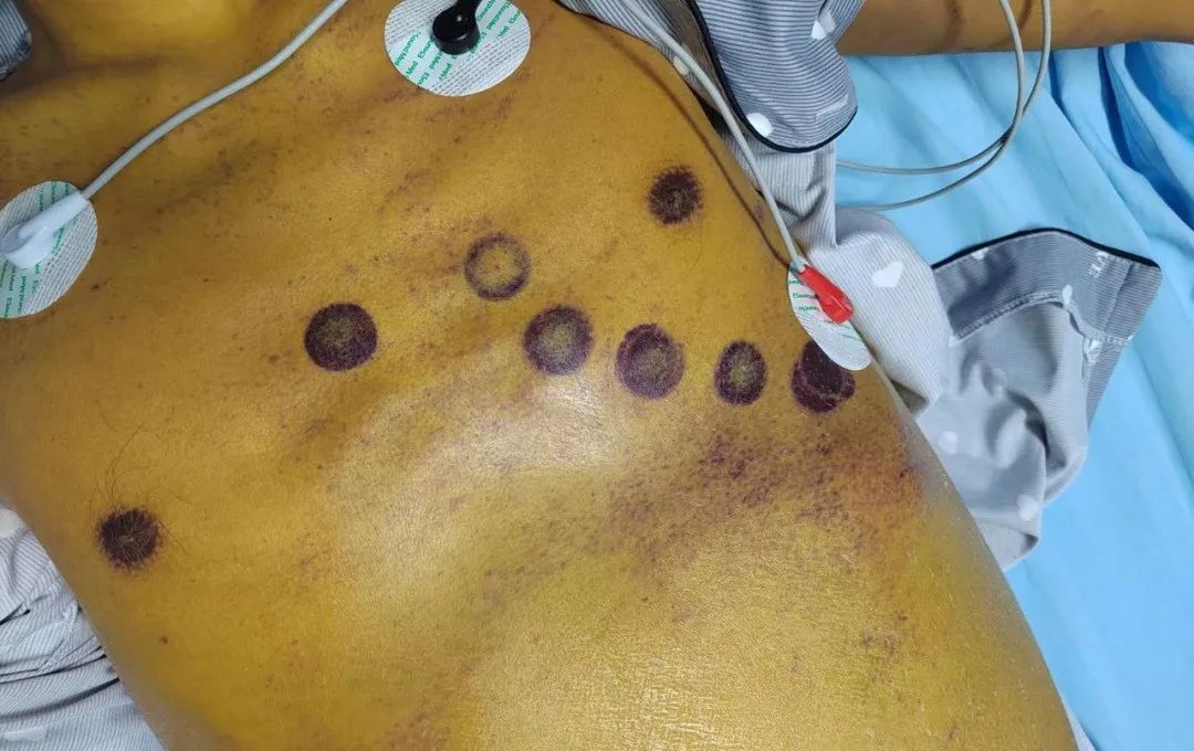 肝不「动」了,人工肝助肝癌「小黄人」获新生