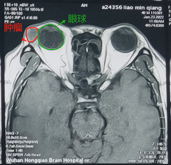 眼皮长了一个包,不痛不痒,15 年后发现竟是泪腺肿瘤