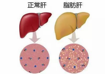 脂肪肝是怎样的一种肝病