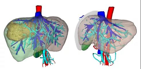 广西壮族自治区人民医院肝胆胰脾外科为肝癌患者完成转化治疗和根治性手术