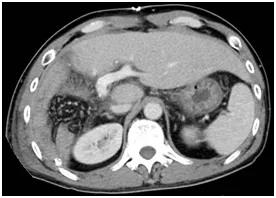 广西壮族自治区人民医院肝胆胰脾外科为肝癌患者完成转化治疗和根治性手术
