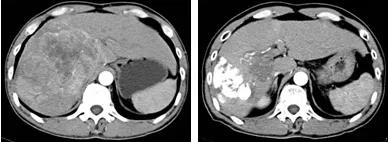 广西壮族自治区人民医院肝胆胰脾外科为肝癌患者完成转化治疗和根治性手术