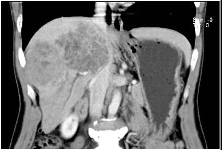 广西壮族自治区人民医院肝胆胰脾外科为肝癌患者完成转化治疗和根治性手术