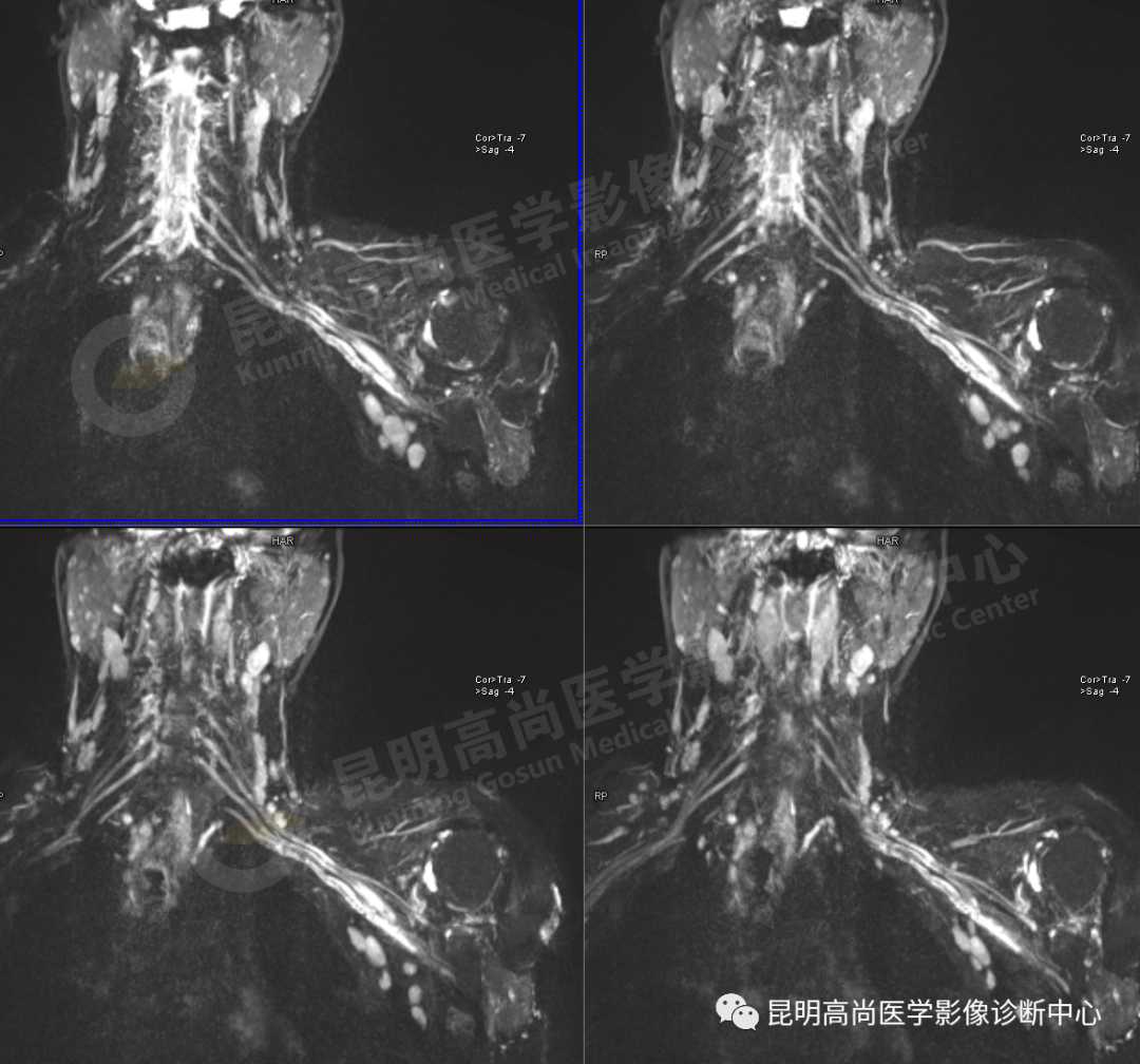 脚趾大拇指指甲两侧往肉里长怎么办啊？ - 知乎