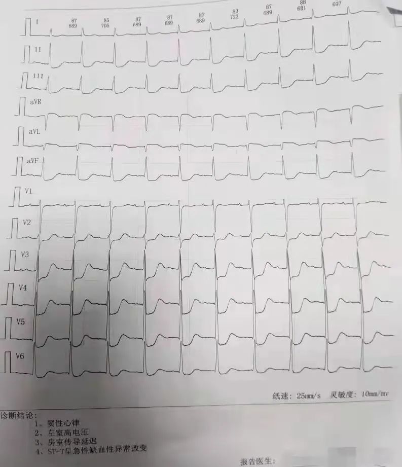 岳池县人民医院胸痛中心成功抢救一名濒死心肌梗死患者