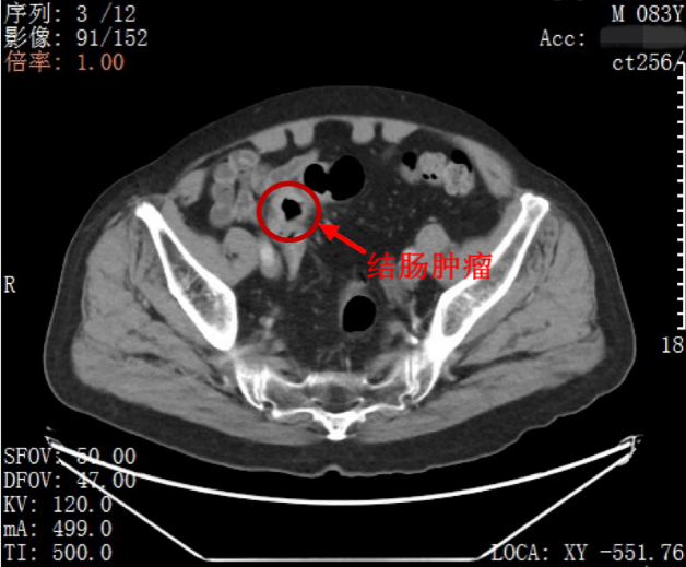 83 岁老人同时罹患胃癌、肠癌，北大深医团队一次性切除两处肿瘤