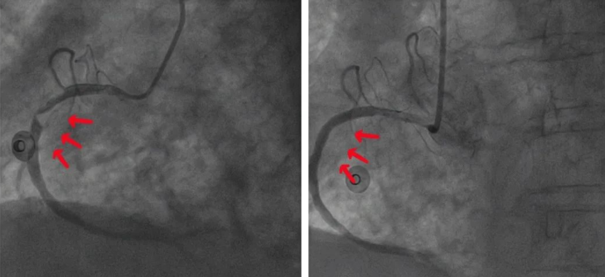 岳池县人民医院胸痛中心成功抢救一名濒死心肌梗死患者